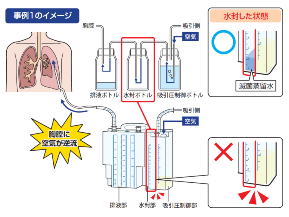 胸腔ドレーンバッグの水封部に滅菌蒸留水を入れないまま接続すると、陰圧の胸腔に空気が逆流し換気が妨げられてしまう
